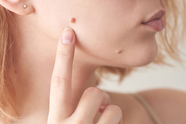 Mole Removal Treatment