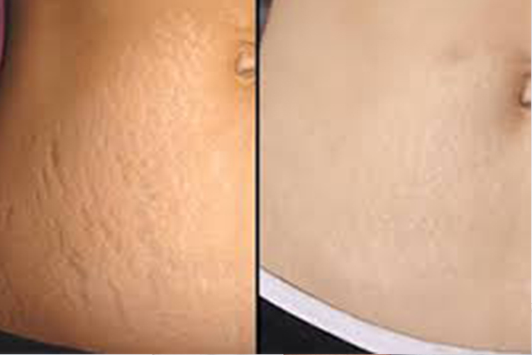 Stretch Marks Treatment
