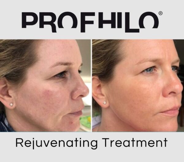 Profhilo Treatment